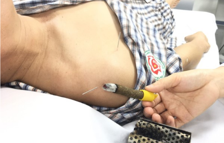 Cứu điều trị viêm quanh khớp vai, tổn thương vai (Kiên thống)